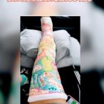 fiber leg cast