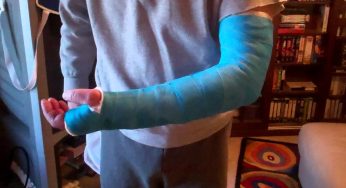 New Blue Long Arm Cast LAC