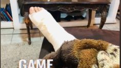 Broken ankle