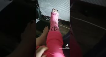 SHORT LEG CAST PINK 😍#legcast