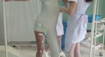 Betty gets Minerva Hip Spica Body Plaster Cast for better grades