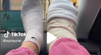 Short leg cast