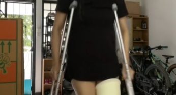 Ann Mica in crutches with long leg cast