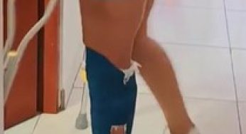 Blue leg cast at home