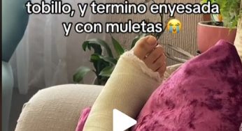 Broken ankle fiberglass cast