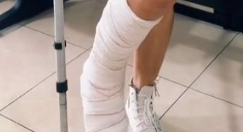 Leg cast with perfect pedicure