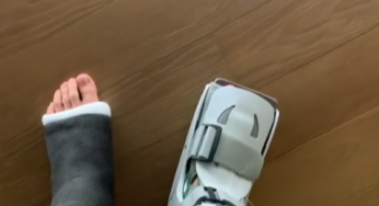 Two broken legs