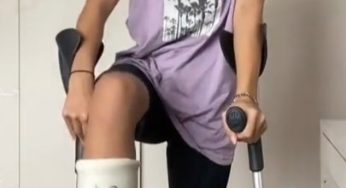 Sexy women in a fiber leg cast with red nails