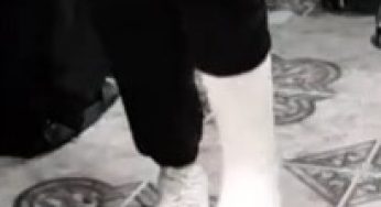 Colombian women in a plaster leg cast