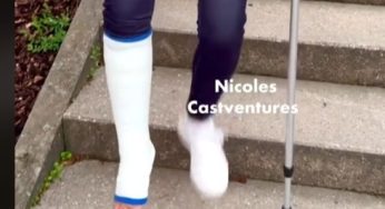 Blue leg nailsin nice leg cast SLC