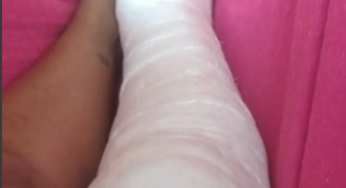Nice plaster long leg cast LLC
