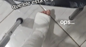 Plaster leg cast SLC
