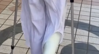 Nice fiber leg cast