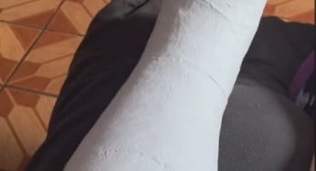 Jou sousa in plaster leg cast SLC