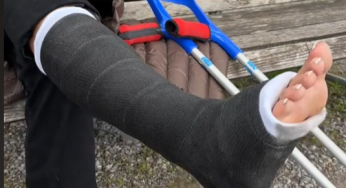 Black leg cast with perfect pedicure