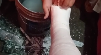 My new cast PLASTER Slc