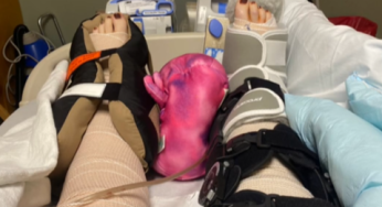 Broken legs