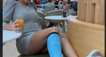 SHOWING MY BLUE LEG CAST IN PUBLIC