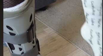 Double leg cast SLC