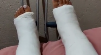 Slc – Gesso 🩼#engessada #gesso Dual broken leg