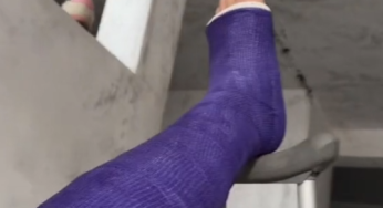 Twice broken leg, fiber cast SLC