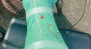 Green leg cast SLC in a normal day