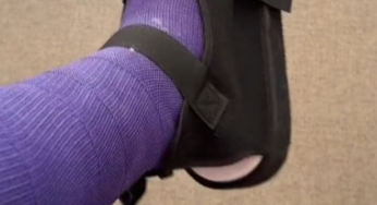 Ya vamos por menos….! try to walking again purple leg cast SLC