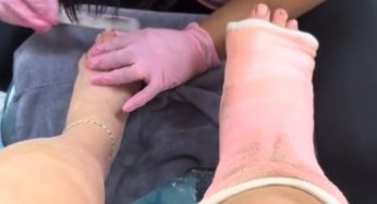 Broken leg… and pedicure