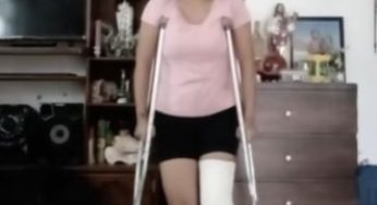 Broken tibia, long leg cast LLC