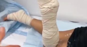 Both broken legs , sexy dual cast