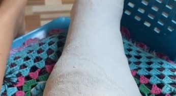 Broken tibia and fibula