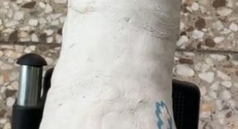 One paw is crushed, the other is fine Plaster cast